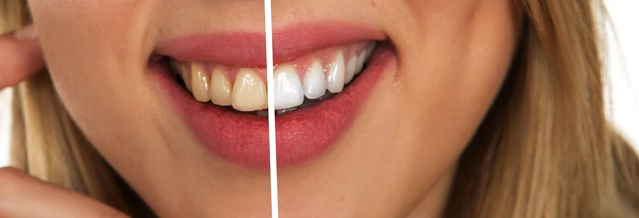 a comparison photo of the before and after of teeth after teeth whitening